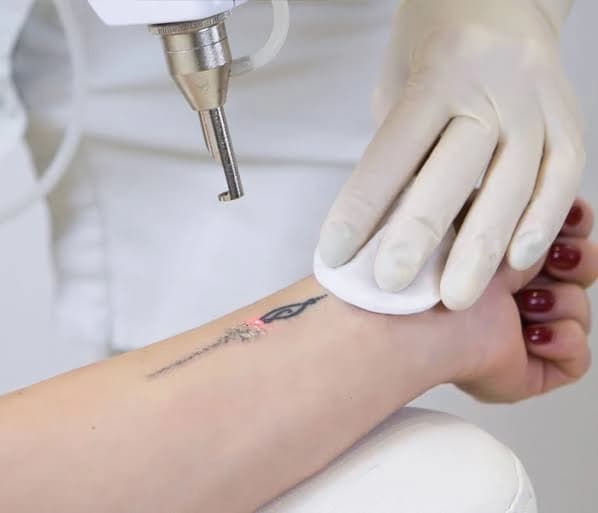 Safe, professional laser tattoo removal treatment