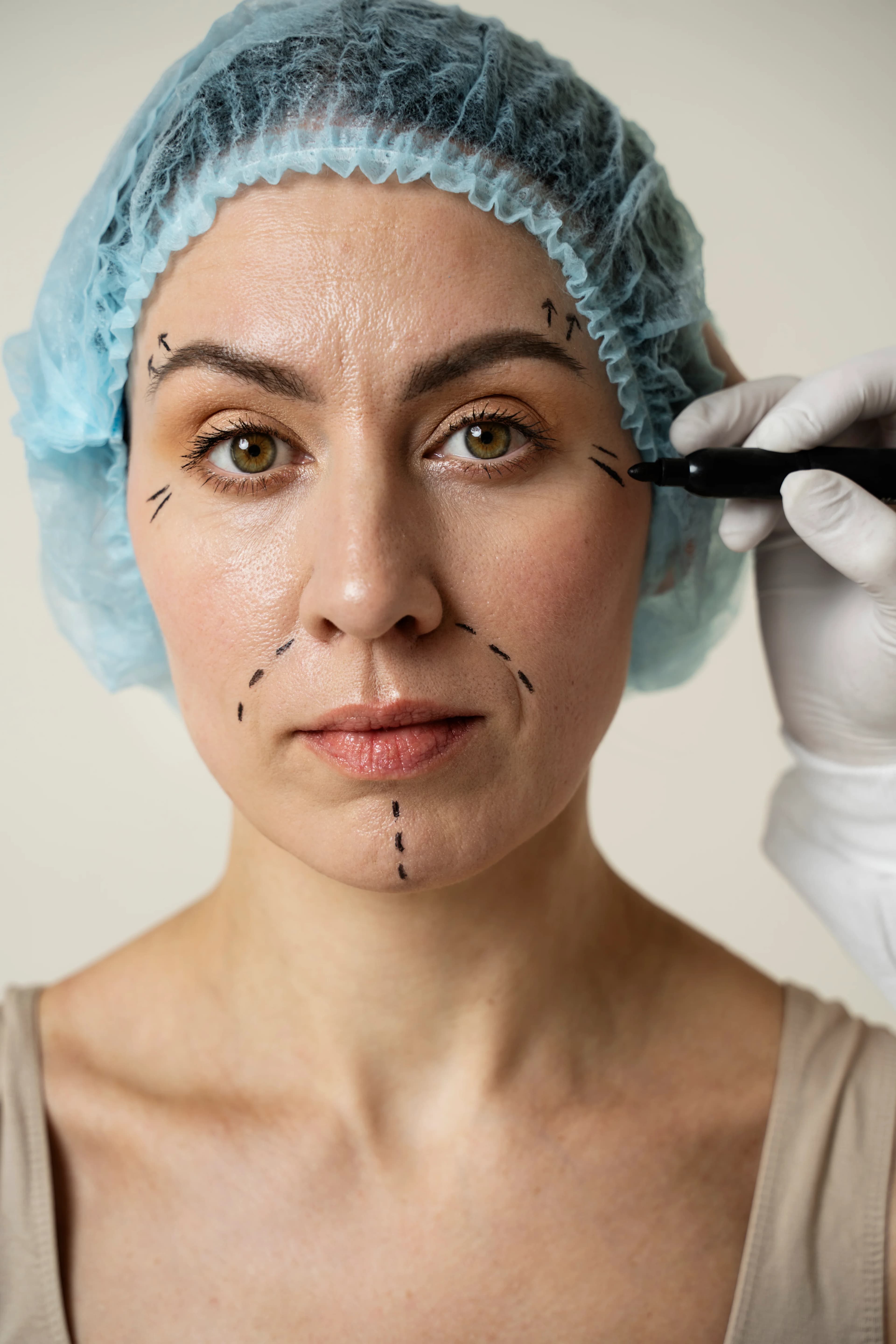 Patient with naturally restored facial volume and smooth under-eyes