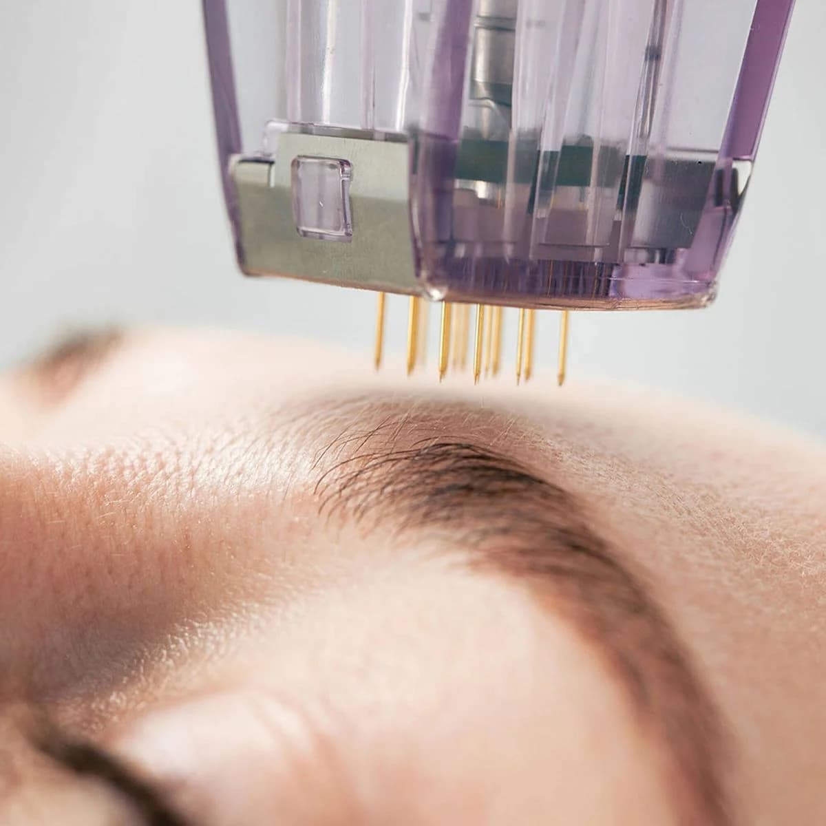 Patient with a perfectly contoured, snatched facial profile